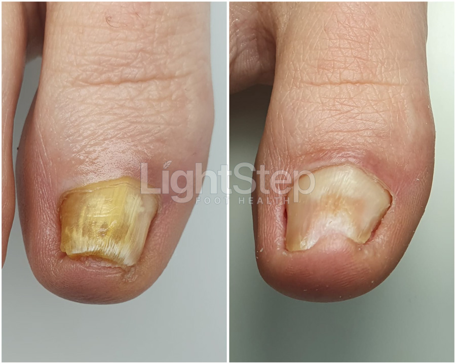 Fungal nail treatment after