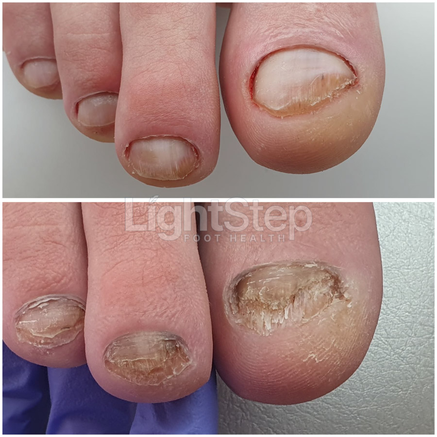 Fungal nail treatment after