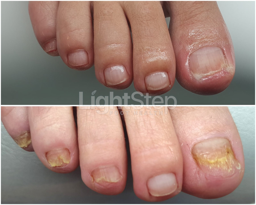 Fungal nail treatment after - LightStep Loughborough