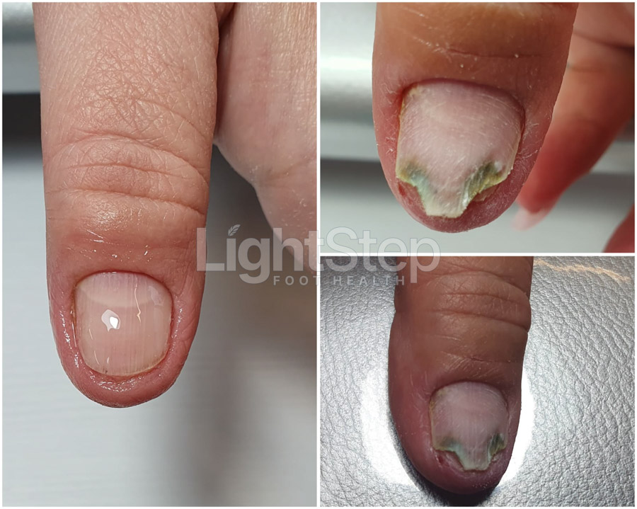 Fungal nail treatment before - LightStep Loughborough